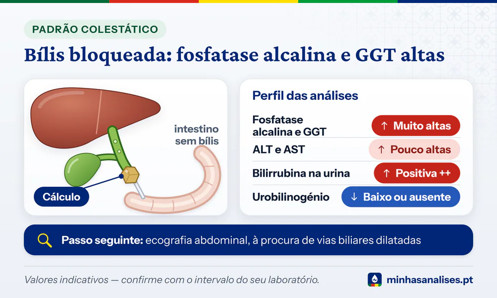 Canal biliar bloqueado por um cálculo e perfil colestático: fosfatase alcalina e GGT muito altas, bilirrubina na urina ++