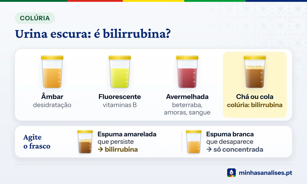 Quatro frascos de urina âmbar, amarelo fluorescente, avermelhada e cor de chá, e o teste da espuma amarelada da bilirrubina